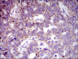 MRPL42 / MRPS32 Antibody - IHC of paraffin-embedded esophageal cancer tissues using MRPL42 mouse monoclonal antibody with DAB staining.