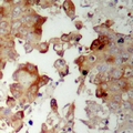 MRPS17 Antibody - Immunohistochemical analysis of MRPS17 staining in human prostate cancer formalin fixed paraffin embedded tissue section. The section was pre-treated using heat mediated antigen retrieval with sodium citrate buffer (pH 6.0). The section was then incubated with the antibody at room temperature and detected using an HRP polymer system. DAB was used as the chromogen. The section was then counterstained with hematoxylin and mounted with DPX.
