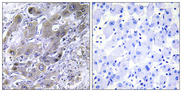 MRPS18A Antibody - Immunohistochemistry analysis of paraffin-embedded human liver carcinoma tissue, using MRPS18A Antibody. The picture on the right is blocked with the synthesized peptide.