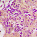 MRPS21 Antibody - Immunohistochemical analysis of MRPS21 staining in human breast cancer formalin fixed paraffin embedded tissue section. The section was pre-treated using heat mediated antigen retrieval with sodium citrate buffer (pH 6.0). The section was then incubated with the antibody at room temperature and detected using an HRP conjugated compact polymer system. DAB was used as the chromogen. The section was then counterstained with hematoxylin and mounted with DPX.