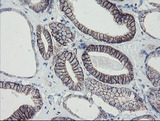 MRPS27 Antibody - IHC of paraffin-embedded Carcinoma of Human prostate tissue using anti-MRPS27 mouse monoclonal antibody.