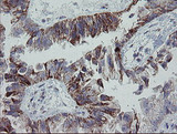 MRPS27 Antibody - IHC of paraffin-embedded Adenocarcinoma of Human ovary tissue using anti-MRPS27 mouse monoclonal antibody.
