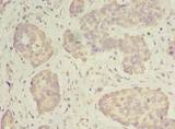 MRPS31 Antibody - Immunohistochemistry of paraffin-embedded human gastric cancer using antibody at dilution of 1:100.