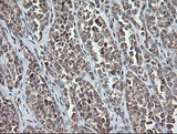 MRPS34 Antibody - IHC of paraffin-embedded Carcinoma of Human thyroid tissue using anti-MRPS34 mouse monoclonal antibody. (Heat-induced epitope retrieval by 10mM citric buffer, pH6.0, 120°C for 3min).