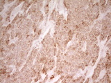 MRRF Antibody - IHC of paraffin-embedded Carcinoma of Human lung tissue using anti-MRRF mouse monoclonal antibody. (Heat-induced epitope retrieval by 1 mM EDTA in 10mM Tris, pH8.5, 120°C for 3min).