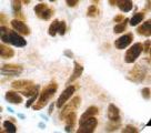 MSH2 Antibody - IHC of MSH2 on FFPE Colon Carcinoma tissue.