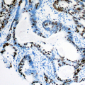 MSH3 Antibody - Immunohistochemical analysis of MSH3 staining in human colon cancer formalin fixed paraffin embedded tissue section. The section was pre-treated using heat mediated antigen retrieval with sodium citrate buffer (pH 6.0). The section was then incubated with the antibody at room temperature and detected using an HRP conjugated compact polymer system. DAB was used as the chromogen. The section was then counterstained with hematoxylin and mounted with DPX.