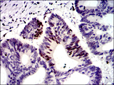 MSH6 Antibody - IHC of paraffin-embedded colon cancer tissues using MSH6 mouse monoclonal antibody with DAB staining.