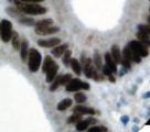 MSH6 Antibody - IHC of MSH6 on FFPE Colon Carcinoma tissue. This image was taken for the unmodified form of this product. Other forms have not been tested.