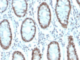 MSH6 Antibody - IHC staining of FFPE human colon carcinoma with MSH6 antibody. HIER: boil tissue sections in pH6, 10mM citrate buffer, for 10-20 min and allow to cool before testing.