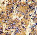 MSRB2 / MSRB Antibody - Formalin-fixed and paraffin-embedded human hepatocarcinoma with MSRB2 Antibody , which was peroxidase-conjugated to the secondary antibody, followed by DAB staining. This data demonstrates the use of this antibody for immunohistochemistry; clinical relevance has not been evaluated.