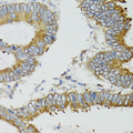 MT-ND5 Antibody - Immunohistochemistry of paraffin-embedded human colon carcinoma tissue.