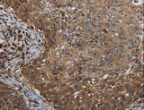 MT-ND6 Antibody - Immunohistochemistry of paraffin-embedded Human cervical cancer using MT-ND6 Polyclonal Antibody at dilution of 1:40.