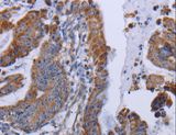 MT3 / Metallothionein 3 Antibody - Immunohistochemistry of paraffin-embedded Human esophagus cancer using MT3 Polyclonal Antibody at dilution of 1:50.