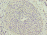 MTFP1 Antibody - Immunohistochemistry of paraffin-embedded human cervical cancer at dilution 1:100