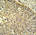 MTHFD1 Antibody - MTHFD1 Antibody (Center P550) IHC of formalin-fixed and paraffin-embedded human Lung carcinoma followed by peroxidase-conjugated secondary antibody and DAB staining. This data demonstrates the use of the MTHFD1 Antibody (Center P550) for immunohistochemistry.