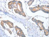 MTMR7 Antibody - Immunohistochemistry of paraffin-embedded Human colon cancer using MTMR7 Polyclonal Antibody at dilution of 1:40.