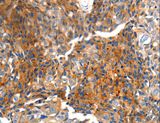 MTNR1A / Melatonin Receptor 1a Antibody - Immunohistochemistry of paraffin-embedded Human breast cancer using MTNR1A Polyclonal Antibody at dilution of 1:100.