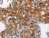 MUC5B Antibody - Immunohistochemistry of paraffin-embedded Human cervical cancer using MUC5B Polyclonal Antibody at dilution of 1:70.