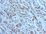 MUC6 / MUC-6 Antibody - IHC testing of FFPE gastric carcinoma with MUC6 antibody (clone CLH5). HIER: steam section in pH6 citrate buffer for 20 min and allow to cool prior to tetsting.