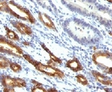 MUC6 / MUC-6 Antibody - Formalin-fixed, paraffin-embedded human gastric carcinoma stained with Mucin-6 antibody (MUC6/916).  This image was taken for the unmodified form of this product. Other forms have not been tested.