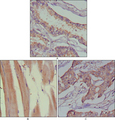 MUSK Antibody - IHC of paraffin-embedded human lung cancer (A), muscles (B) and breast cancer (C) using MUSK mouse monoclonal antibody with DAB staining.