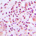 MUTYH / MYH Antibody - Immunohistochemical analysis of MUTYH staining in human lung cancer formalin fixed paraffin embedded tissue section. The section was pre-treated using heat mediated antigen retrieval with sodium citrate buffer (pH 6.0). The section was then incubated with the antibody at room temperature and detected using an HRP conjugated compact polymer system. DAB was used as the chromogen. The section was then counterstained with hematoxylin and mounted with DPX.