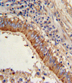 MVP / VAULT1 Antibody - Formalin-fixed and paraffin-embedded human lung carcinoma with MVP Antibody , which was peroxidase-conjugated to the secondary antibody, followed by DAB staining. This data demonstrates the use of this antibody for immunohistochemistry; clinical relevance has not been evaluated.