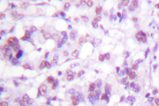 MYB / c-Myb Antibody - IHC of MYB (R6) pAb in paraffin-embedded human breast carcinoma tissue.