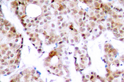 MYC / c-Myc Antibody - IHC of p-Myc (T58) pAb in paraffin-embedded human breast carcinoma tissue.