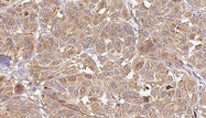 MYDGF / SF20 Antibody - 1:100 staining human Melanoma tissue by IHC-P. The sample was formaldehyde fixed and a heat mediated antigen retrieval step in citrate buffer was performed. The sample was then blocked and incubated with the antibody for 1.5 hours at 22°C. An HRP conjugated goat anti-rabbit antibody was used as the secondary.