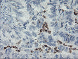 MYL7 Antibody - IHC of paraffin-embedded Adenocarcinoma of Human ovary tissue using anti-MYL7 mouse monoclonal antibody.