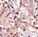 MYLK Antibody - Formalin-fixed and paraffin-embedded human cancer tissue reacted with the primary antibody, which was peroxidase-conjugated to the secondary antibody, followed by DAB staining. This data demonstrates the use of this antibody for immunohistochemistry; clinical relevance has not been evaluated. BC = breast carcinoma; HC = hepatocarcinoma.
