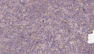MYO18A Antibody - 1:100 staining human lymph carcinoma tissue by IHC-P. The sample was formaldehyde fixed and a heat mediated antigen retrieval step in citrate buffer was performed. The sample was then blocked and incubated with the antibody for 1.5 hours at 22°C. An HRP conjugated goat anti-rabbit antibody was used as the secondary.