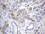 N4BP2L2 Antibody - IHC of paraffin-embedded Carcinoma of Human pancreas tissue using anti-N4BP2L2 mouse monoclonal antibody. (Heat-induced epitope retrieval by 1 mM EDTA in 10mM Tris, pH8.5, 120°C for 3min).