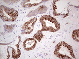 N4BP2L2 Antibody - IHC of paraffin-embedded Carcinoma of Human prostate tissue using anti-N4BP2L2 mouse monoclonal antibody. (Heat-induced epitope retrieval by 1 mM EDTA in 10mM Tris, pH8.5, 120°C for 3min).