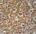 N4BP3 Antibody - N4BP3 Antibody immunohistochemistry of formalin-fixed and paraffin-embedded human cervix carcinoma followed by peroxidase-conjugated secondary antibody and DAB staining.
