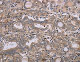 NAA25 Antibody - Immunohistochemistry of paraffin-embedded Human thyroid cancer using NAA25 Polyclonal Antibody at dilution of 1:40.