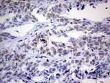 NAB1 Antibody - IHC of paraffin-embedded Adenocarcinoma of Human endometrium tissue using anti-NAB1 mouse monoclonal antibody. (Heat-induced epitope retrieval by 1 mM EDTA in 10mM Tris, pH9.0, 120°C for 3min).
