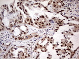 NAE1 / APPBP1 Antibody - IHC of paraffin-embedded Carcinoma of Human lung tissue using anti-NAE1 mouse monoclonal antibody. (Heat-induced epitope retrieval by 1 mM EDTA in 10mM Tris, pH8.5, 120°C for 3min).