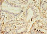 NAIF1 Antibody - Immunohistochemistry of paraffin-embedded human breast cancer using antibody at dilution of 1:100.