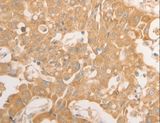 NAP1L1 Antibody - Immunohistochemistry of paraffin-embedded Human lung cancer using NAP1L1 Polyclonal Antibody at dilution of 1:50.