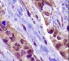 NAPSA / NAPA / Napsin A Antibody - NAPSIN1 Antibody (TMU-Ad02) - IHC of Napsin1 on human lung adenocarcinoma.  This image was taken for the unconjugated form of this product. Other forms have not been tested.