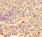 NAPSA / NAPA / Napsin A Antibody - Immunohistochemistry of paraffin-embedded human lung cancer using NAPSA Antibody at dilution of 1:100