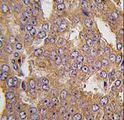 NARS2 Antibody - Formalin-fixed and paraffin-embedded human prostate carcinoma tissue reacted with NARS2 antibody , which was peroxidase-conjugated to the secondary antibody, followed by DAB staining. This data demonstrates the use of this antibody for immunohistochemistry; clinical relevance has not been evaluated.