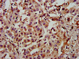 NAT15 Antibody - Immunohistochemistry image at a dilution of 1:900 and staining in paraffin-embedded human liver cancer performed on a Leica BondTM system. After dewaxing and hydration, antigen retrieval was mediated by high pressure in a citrate buffer (pH 6.0) . Section was blocked with 10% normal goat serum 30min at RT. Then primary antibody (1% BSA) was incubated at 4 °C overnight. The primary is detected by a biotinylated secondary antibody and visualized using an HRP conjugated SP system.