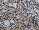 NBL1 / DAN Antibody - Immunohistochemistry of paraffin-embedded Human thyroid cancer using NBL1 Polyclonal Antibody at dilution of 1:50.