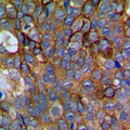 NCALD / Neurocalcin Delta Antibody - Immunohistochemical analysis of NCALD staining in human prostate cancer formalin fixed paraffin embedded tissue section. The section was pre-treated using heat mediated antigen retrieval with sodium citrate buffer (pH 6.0). The section was then incubated with the antibody at room temperature and detected using an HRP conjugated compact polymer system. DAB was used as the chromogen. The section was then counterstained with hematoxylin and mounted with DPX.