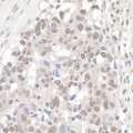 NCBP1 / CBP80 Antibody - Detection of human NCBP1/CBP80 by immunohistochemistry. Sample: FFPE section of human ovarian carcinoma. Antibody: Affinity purified rabbit anti- NCBP1/CBP80 used at a dilution of 1:1,000 (1µg/ml). Detection: DAB