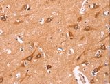NCEH1 / AADACL1 Antibody - Immunohistochemistry of paraffin-embedded Human thyroid cancer using NCEH1 Polyclonal Antibody at dilution of 1:80.